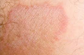 Image result for penis mycosis symptoms