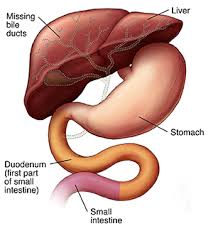 Image result for Intestinal Atresia