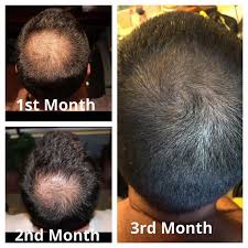 Thinning Or Balding Hair Try Monat S Classic Confidence System Nontoxic No Side Effects 30 Day Money Bac Hair Growth For Men Hair Loss Men Hair Loss Treatment