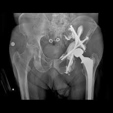 Cancer occurs when cells' normal growth cycle becomes disrupted and causes them to grow abnormally and out of control. Musculoskeletal Tumors Denver Bone Tumors Malignant Tumors Denver