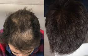 Maybe you would like to learn more about one of these? Before And After Hair Transplant Step By Step Situation Rephair