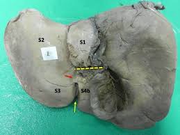 Some of the ligaments are from peritoneum, but some are from blood vessels. Human Liver Umbilical Fissure Variants Pons Hepatis Ligamentum Teres Tunnel Springerlink