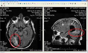 Лечение энцефалопатии сопряжено с использованием одновременно нескольких методик. Discirkulyatornaya Encefalopatiya Narusheniya Pamyati Pri Zabolevanii Mrt Ekspert