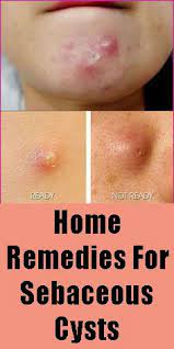 Home Remedies For Sebaceous Cysts Cysts Natural Health Tips Remedies
