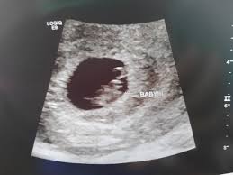 Pregnancy After Tubal Ligation Babycenter