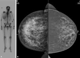 Image result for Inflammatory breast cancer