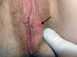 Foto de herpes genital