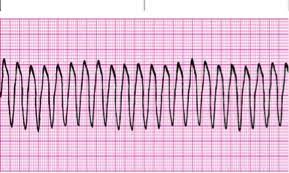 Cardiac Rhythm Strips Cardiac Rhythms Ekg Rhythms Ekg Strips