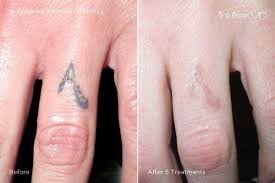 To do this, you need to write in the search box (for example, google) how many sessions to remove a tattoo and add to it an additional word. Tattoo Removal Inkfree Md Laser Clinic Houston Tx