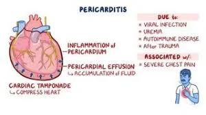 Image result for Pericarditis