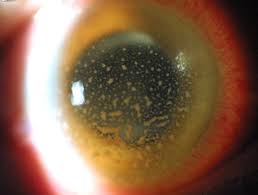 Early diagnosis and treatment are important to prevent complications uveitis. Look For Clues To Simplify Anterior Uveitis Diagnosis