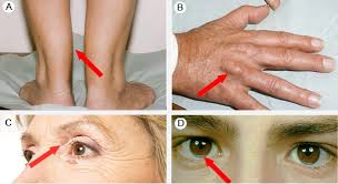 Image result for Hypercholesterolemia