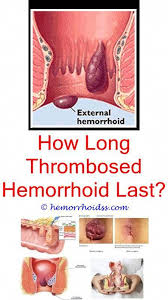Hemorrhoids on the inside are called internal hemorrhoids, and those on the outside are called thrombosed hemorrhoids occur when either an internal or external hemorrhoid fills with blood clots. Do Guys Mind Hemorrhoids What Do Hemorrhoids Cause How Do You Get Rid Of Thrombosed Exte Getting Rid Of Hemorrhoids Thrombosed Hemorrhoid Hemorrhoid Remedies