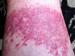 Disney Rash Definition Treatment And Prevention