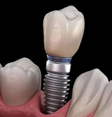 Image result for dental implant