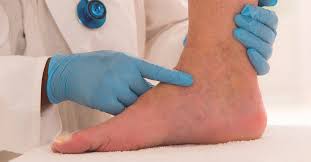 Non Pitting Edema Pitting Vs Non Pitting Causes And