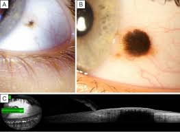 Image result for nevus sclerae