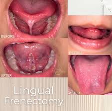 Image result for Ankyloglossia