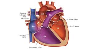 Image result for Atrial Septal Defect