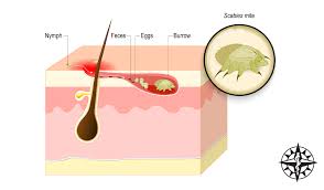 Image result for scabies symptoms