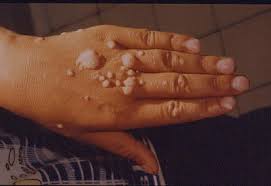 Resultado de imagem para foto hpv