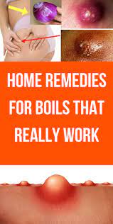 We did not find results for: Home Remedies For Boils That Really Work Home Remedies For Boils Remedies For Boils Skin Boil