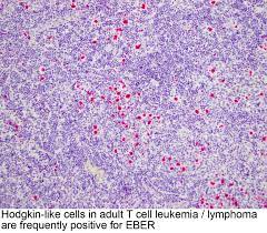 Anubha bajaj* ab diagnostics, new delhi, india. Pathology Outlines Atll