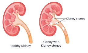 Best Kidney Stone Hospital In Ludhiana Renal Stone Surgery Cost In Punjab
