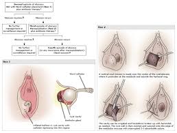 Image result for Bartholin's gland abscess