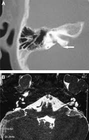 Imaging Findings Of Large Vestibular Aqueduct Syndrome A Ct Scan Download Scientific Diagram