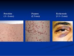 This can create purple spots on the skin that range in size from small often, petechiae are nothing to worry about. Petekier Purpura Echimoser Petechiae Bleeding Hematom Hematoma Ecchymosis This Website Has No Commercial Interest Only Personal Reflections