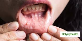 Can depression be cured only by exercising n doin yoga regularly or. Early Signs And Symptoms Of Oral Cancer And Ways To Prevent Mouth Cancer In Hindi