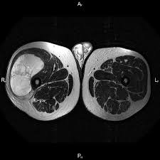 Image result for Liposarcoma