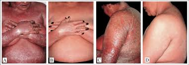 Sabe quais os tipos de psoríase???? A B C E D Psoriase Eritrodermica Tratada Com Acitretina Download Scientific Diagram
