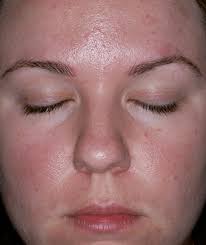 Benzoyl peroxide versus topical erythromycin in the treatment of acne vulgaris.br j dermatol. Ipl Acne Treatment Proskin Clinic Adelaide Cbd Country Sa