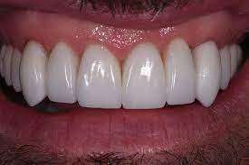 This post will guide you on how to make vampire fangs with household items that are readily repeat it with the other side. Vampire Teeth Fang Feels Cosmetic Dentist Auckland