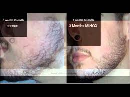 No one will distinguish between natural beard and beard that grew because of minoxidil. Minoxidil Beard Growth Before After Youtube