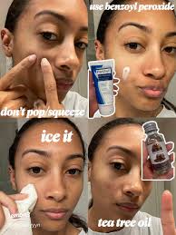 19 top How to Get Rid of A Pimple Awith No Head ideas in 2024