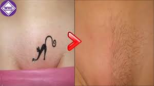 An estimated 60% of young women remove their pubic hair. No Shave No Wax How To Remove Pubic Hair Pubic Hair Removal Remedies 2018 Youtube