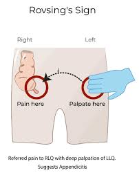 Image result for Psoas Sign
