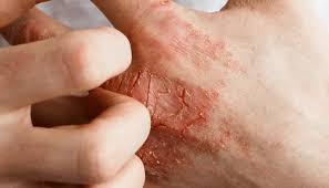 Image result for Hand Infection
