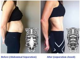 Before And After Pictures Of Mom Belly Diastasis Mom Belly Mommy Pooch Mom Tummy