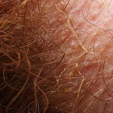 These make up your natural hair and skin color. Causes Of White Brown Or Grey Coloured Armpit And Pubic Hair
