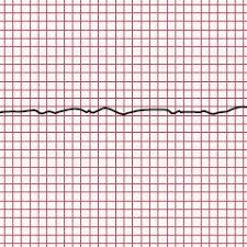 Download plabkeys version 2 (2020) pdfs updated (10,080). Pdf Understanding The Ecg Part 10 Pacing Drugs And Electrolytes