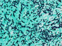 Rhizopus species are the most common causative organisms. Invasive Fungal Orbitorhinocerebral Mucormycosis Eyerounds Org Ophthalmology The University Of Iowa