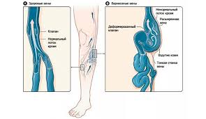 Check spelling or type a new query. Seberapa Berkesan Rawatan Vena Varikos Dengan Bantuan Remedi Rakyat Bolehkah Rawatan Vena Varikos Di Rumah Apa Ubat Ubatan Yang Berkesan Dari Perubatan Tradisional Akan Datang Untuk Menyelamatkan