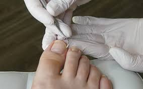 nagelfalz reinigen und sondieren fusspflegeblog