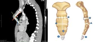 Poland syndrome and breast prostheses. Modified Ravitch Procedure For Left Poland Syndrome Combined With Pectus Excavatum Sciencedirect