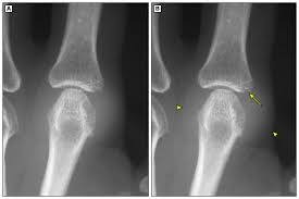 Image result for XRay Changes in Rheumatic Conditions