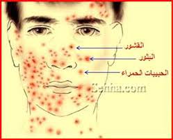 ملف كامل بل صور عن الجديري المائي العنقز Chickenpox Varicella